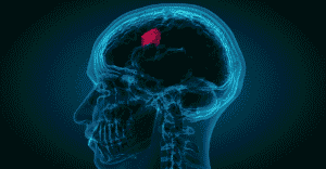 Is Brain Tumor Always A Cancer?
